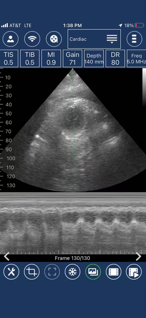 EdgeLife - Interfaz de la aplicación móvil que muestra un escaneo de ultrasonido cardíaco con datos de diagnóstico médico.