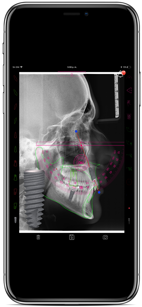 CEPH APP  By ORTHOKINETIC APPS - Lateral cephalometric x-ray analysis with digital tracing and dental implant planning
