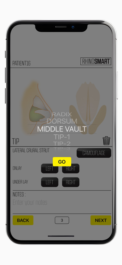 Rhino Smart - Rhino Smart app interface for documenting rhinoplasty surgery with nasal anatomy diagrams