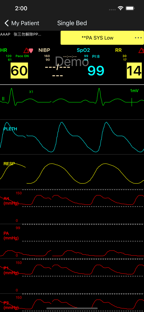 EDAN CMS - Dashboard dell'app mobile EDAN CMS che visualizza parametri vitali e forme d'onda del paziente in tempo reale