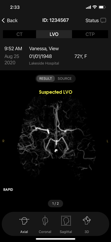 RapidAI mobile interface showing a brain scan with a suspected LVO result