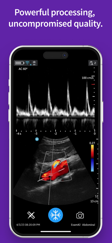 Aplicación Vscan Air que muestra doppler color abdominal y ecografía de onda pulsada en iPhone