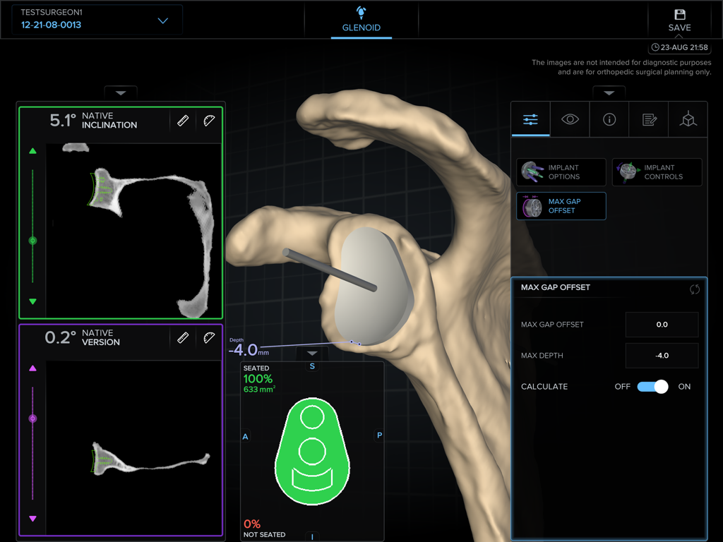 ArthrexVIP app interface showing a 3D model of a scapula with a glenoid implant and preoperative surgical planning data including max gap offset and seating percentage.