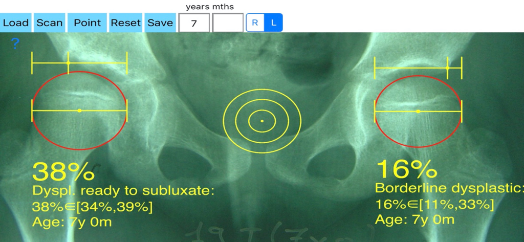 ReimersIndexApp | Hip Dysplasia & Migration Index Calculator
