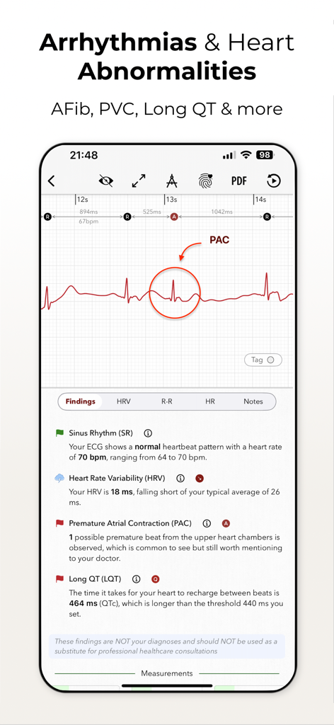 ECG+ | Your Watch ECG Reader - iPhone screen of ECG plus app analyzing heart rhythms for abnormalities like PAC and Long QT.