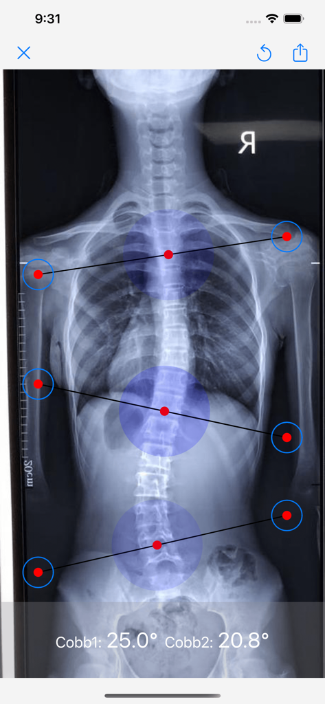 Spinal X-ray with automated Cobb angle measurements for scoliosis diagnosis