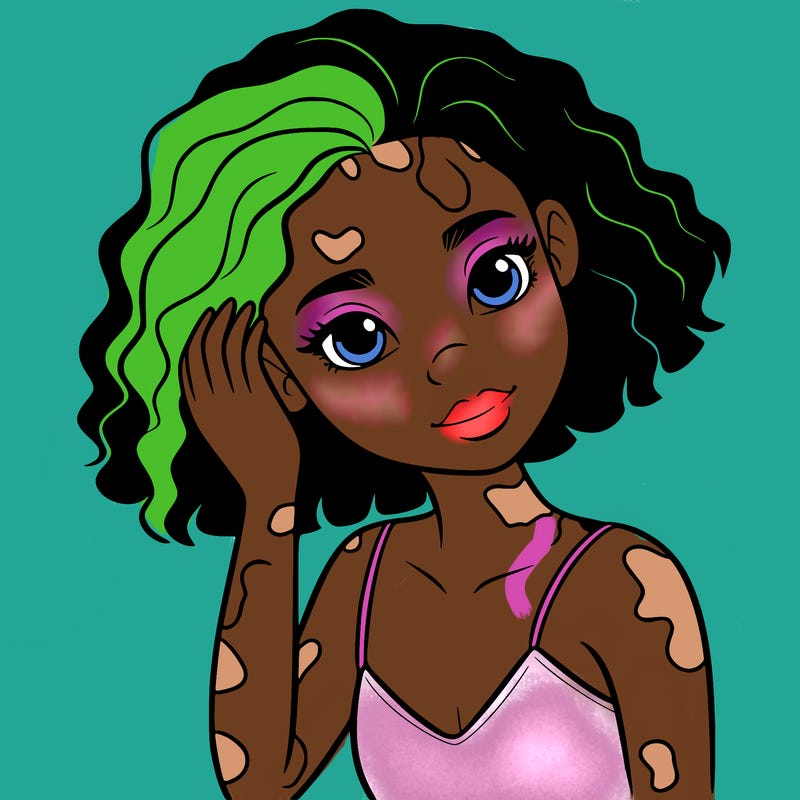 vitiligo black girl