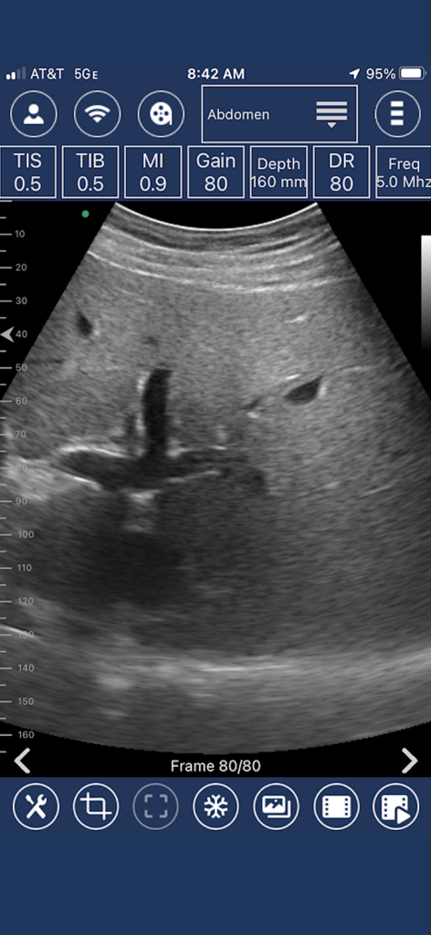 EdgeLife - Interfaz de la aplicación móvil EdgeLife que muestra un escaneo de ultrasonido abdominal convexo con parámetros de diagnóstico técnicos