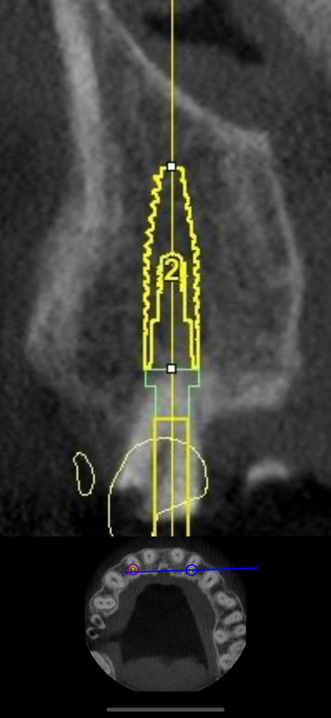 Dental CT View - Cross-sectional dental CT scan visualizing a planned dental implant within the bone