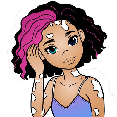 vitiligo black girl