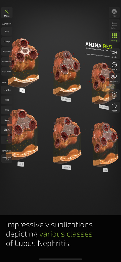 INSIGHT KIDNEY - 3D anatomical visualizations showing different stages and classes of Lupus Nephritis within the Insight Kidney app interface