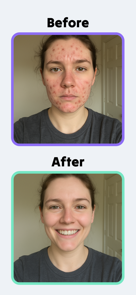 Skincare Scan - Sana - 심각한 여드름에서 맑고 건강한 피부로 변신한 여성의 비포 & 애프터 비교 사진