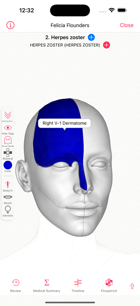 EZDERM app interface showing a 3D head model highlighting the Right V-1 Dermatome for a Herpes zoster clinical entry.