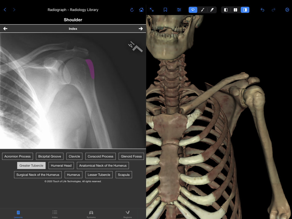 VH Dissector Pro - Split-screen view showing a labeled shoulder radiograph alongside a 3D skeletal model in VH Dissector Pro.