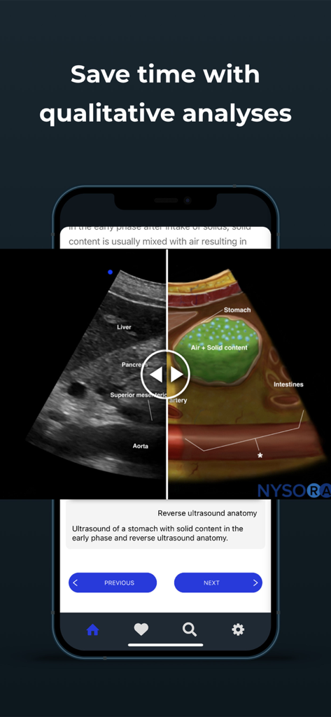 Point of Care Ultrasound - Comparação lado a lado de um exame de ultrassom gástrico real e uma ilustração anatômica rotulada mostrando o estômago com ar e conteúdo sólido