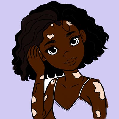vitiligo black girl