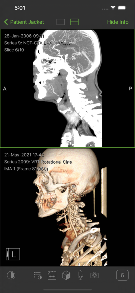 Visage Ease - Split screen interface of the Visage Ease app showing a 2D brain CT scan and a 3D volume rendering of a skull and neck.