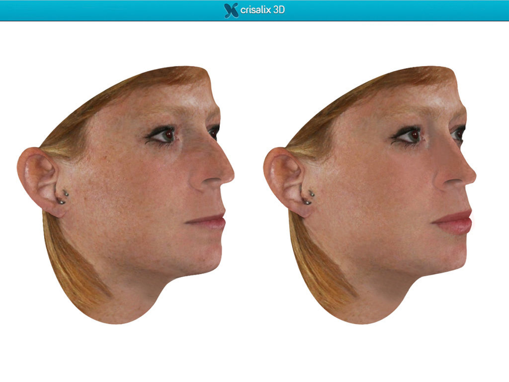 Simulación facial 3D lado a lado comparando resultados de procedimientos estéticos antes y después