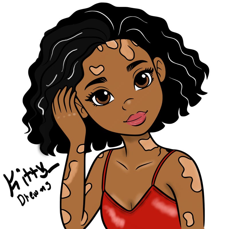 vitiligo black girl