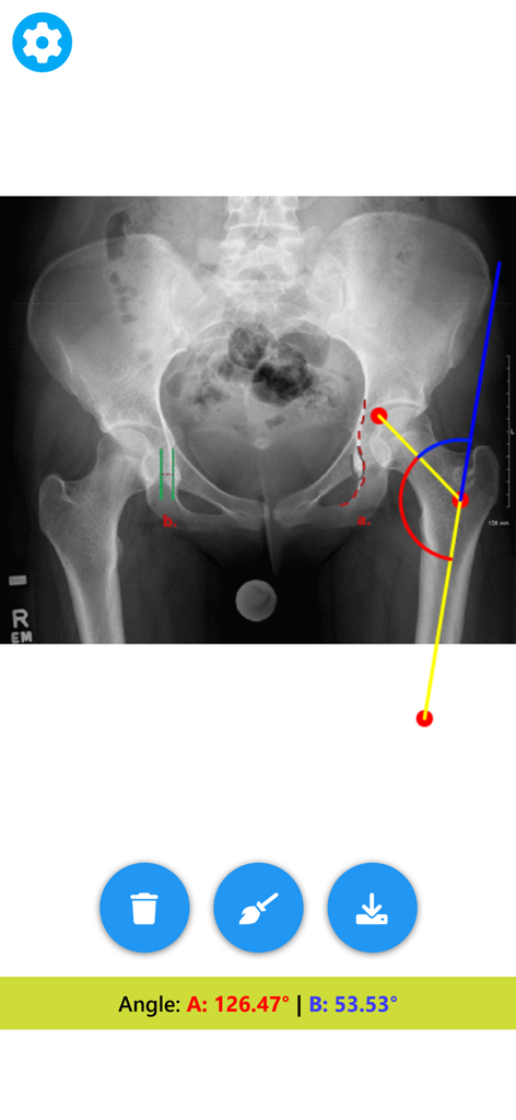 Angle Meter & Cobb Angle Meter - Medical angle meter measuring angles on a pelvic X-ray