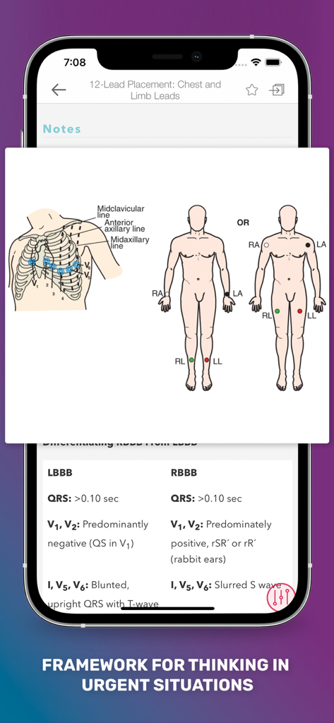 MedSurg Notes: Nurse Pkt Guide - La aplicación MedSurg Notes muestra diagramas de colocación de electrodos de ECG de 12 derivaciones y una tabla comparativa para hallazgos clínicos de LBBB y RBBB.