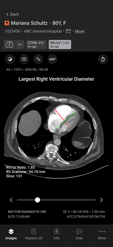 Aidoc - Interface do aplicativo Aidoc mostrando uma tomografia computadorizada com medição cardíaca impulsionada por IA para profissionais médicos