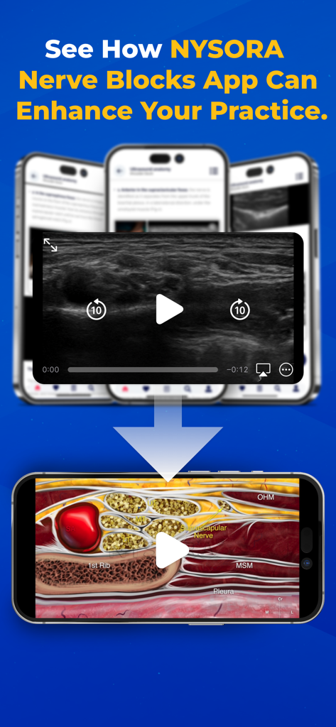 NYSORA Nerve Blocks - A comparison between a live ultrasound video and a detailed anatomical illustration of a nerve block procedure within the NYSORA app.