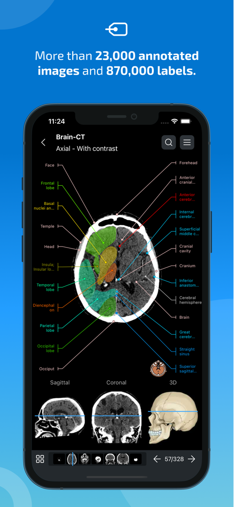 Exame de TC cerebral axial anotado com rótulos médicos em uma tela de smartphone.