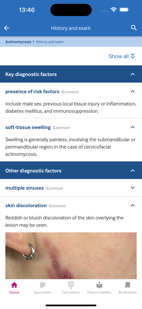 BMJ Best Practice app showing clinical history and exam details for actinomycosis including diagnostic factors and skin lesion image.