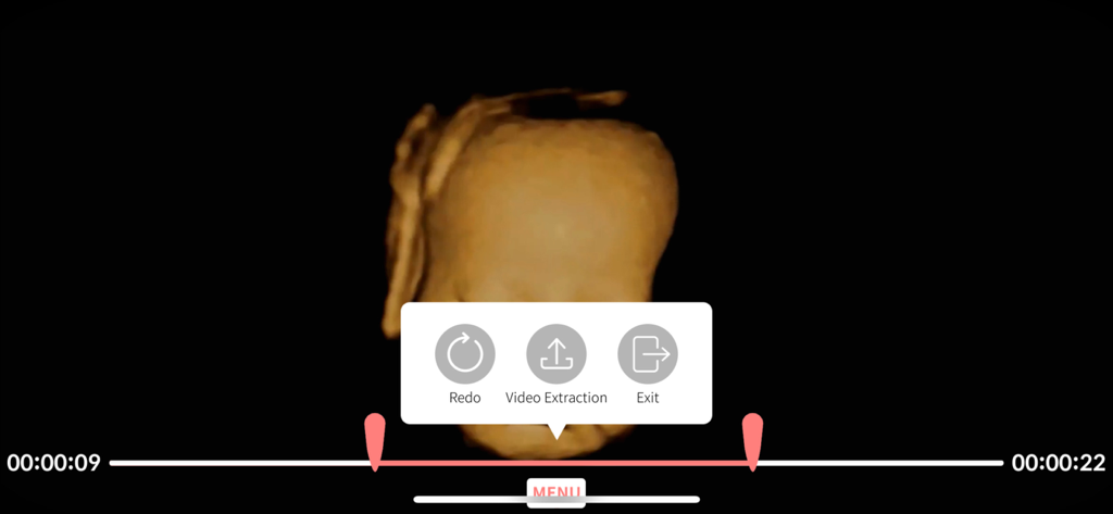 Aluvuu Fetus - Interface for editing and extracting ultrasound videos featuring a 3D model of a baby fetus