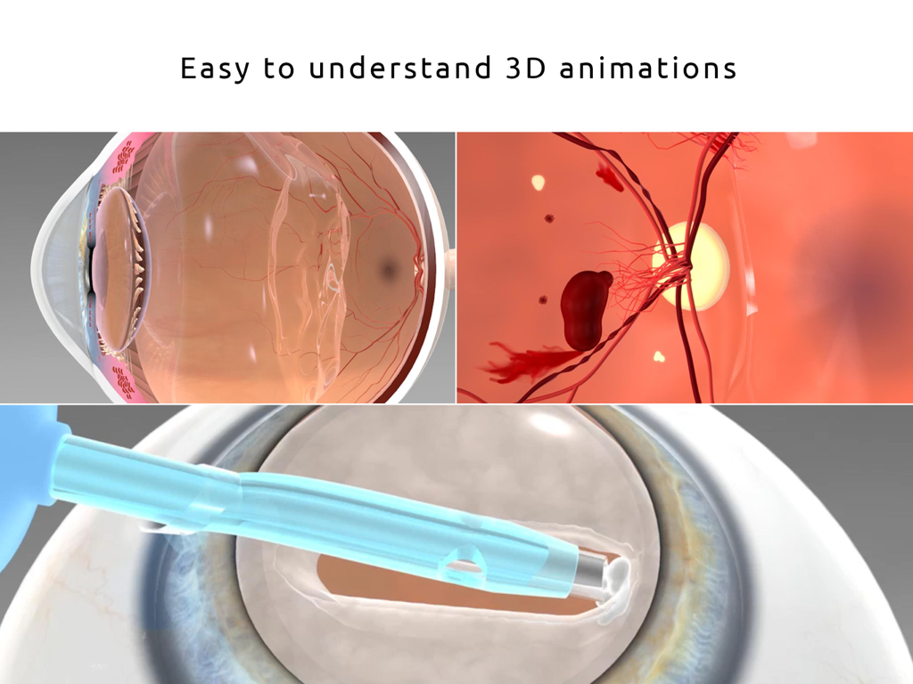 Easy Eye - Animations 3D illustrant l'anatomie de l'œil et les interventions chirurgicales à des fins pédagogiques pour les patients