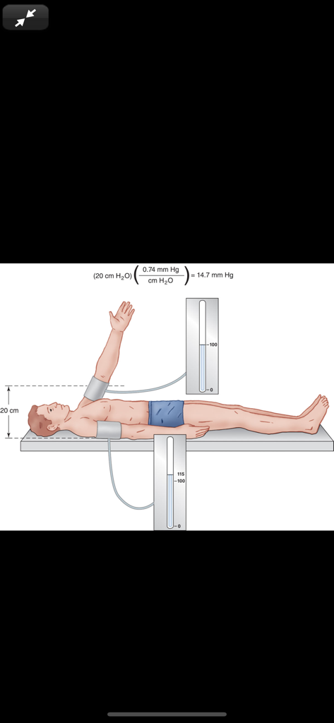 Clinical Anesthesiology, 7/E - Medical diagram illustrating the effect of hydrostatic pressure on blood pressure measurement with a supine patient