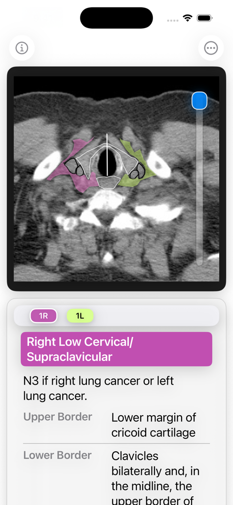 Una TC torácica con superposiciones codificadas en rosa y verde para las estaciones de ganglios linfáticos 1R y 1L