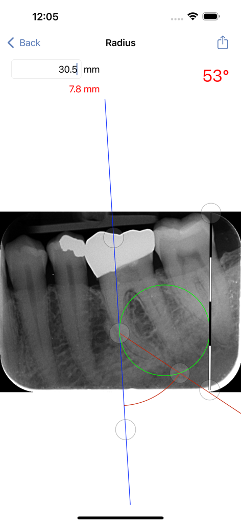 EndoPrep - EndoPrep app interface showing a dental radiograph with radius and angle measurements