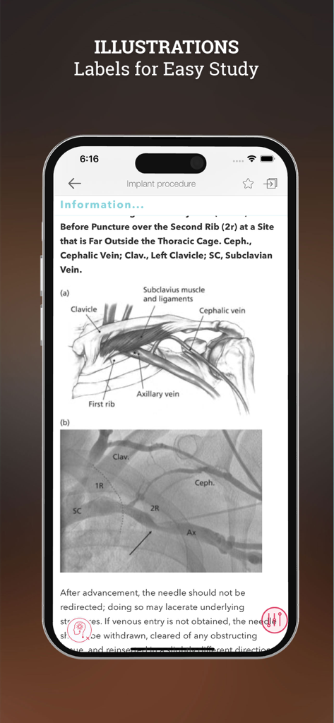 Cardiac Pacing and ICDs - Captura de tela do aplicativo Estimulação Cardíaca e CDsI mostrando diagramas anatômicos rotulados e imagens de fluoroscopia de um procedimento de implante para estudo médico.