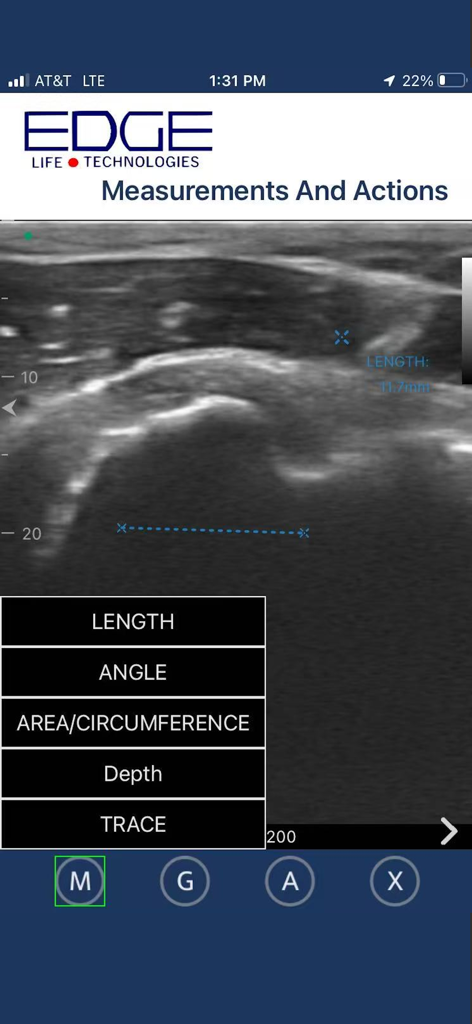 EdgeLife - Interfaz de la aplicación móvil EdgeLife que muestra un escaneo de ultrasonido con herramientas de medición y acciones clínicas