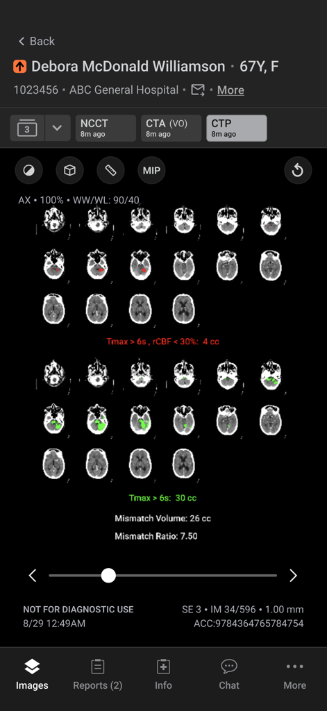 Aidoc - Interface do aplicativo móvel Aidoc exibindo análise automatizada de tomografia computadorizada de perfusão cerebral e volume de mismatch para triagem de AVC.