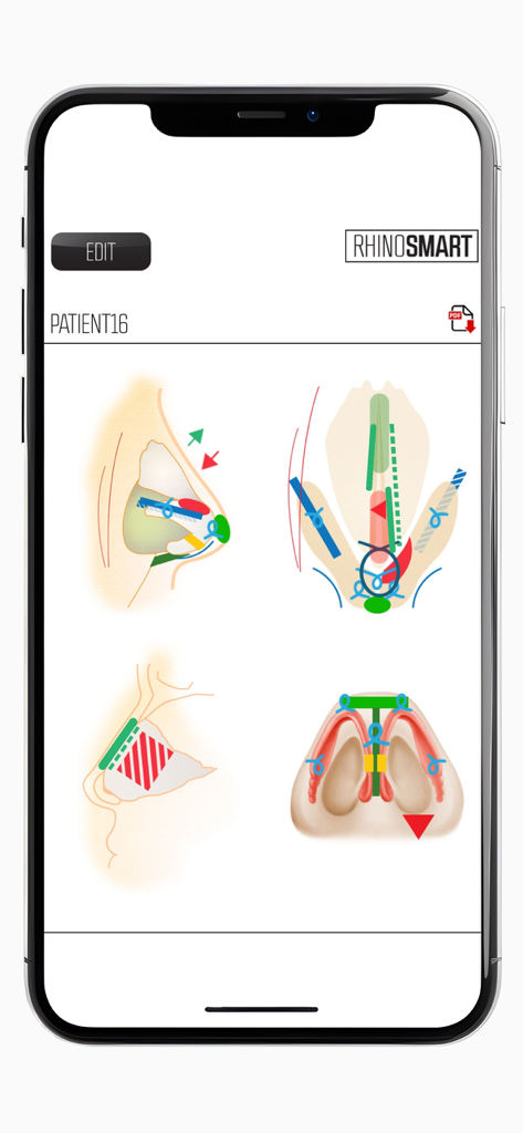 Rhino Smart - Rhino Smart app interface displaying detailed rhinoplasty surgical diagrams and patient procedure documentation