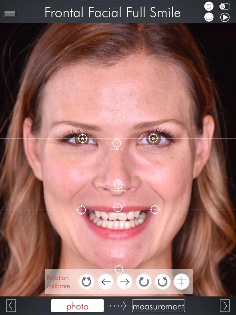 DSD App - Frontal facial analysis interface in the DSD App showing landmark mapping for smile design