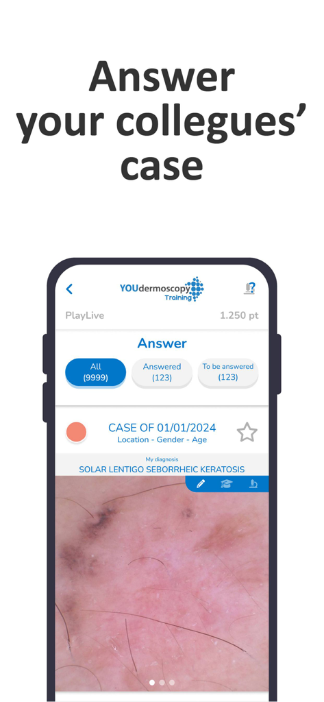 YOUdermoscopy - Captura de pantalla de la función Play Live de la aplicación YOUdermoscopy que muestra un caso de lesión cutánea para diagnóstico por pares