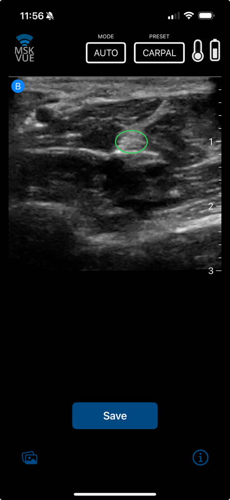 MSK VUE - MSK VUE app interface showing a carpal ultrasound scan with AI-assisted anatomical structure identification
