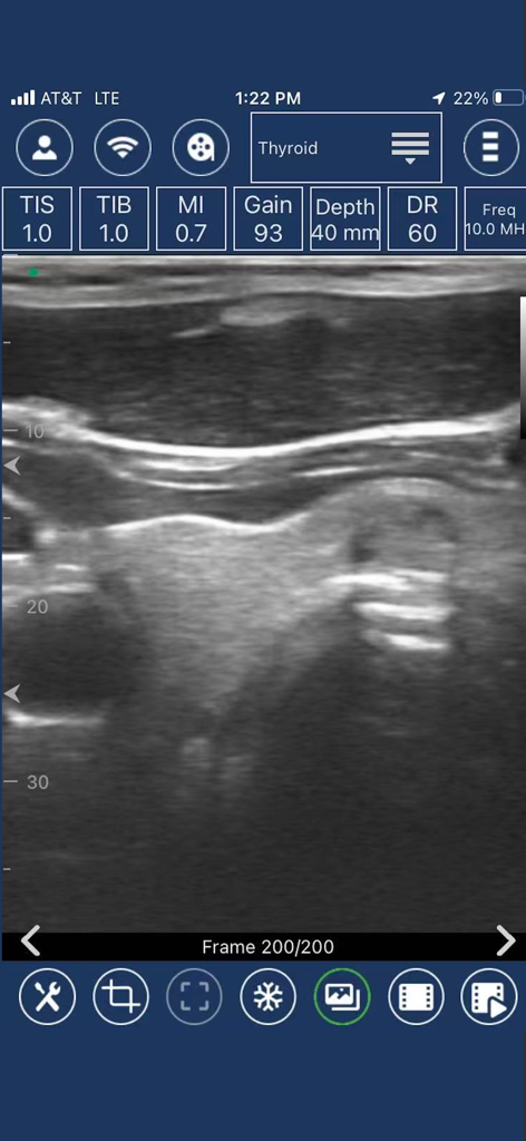 EdgeLife - Interfaz de la aplicación móvil EdgeLife que muestra un escaneo clínico de ultrasonido de tiroides con configuraciones de diagnóstico