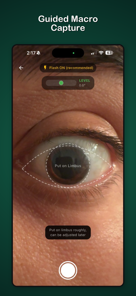 Toric IOL - Interface of the Toric IOL app showing a guided macro capture of a human eye with digital overlays for limbus alignment and a horizontal level indicator