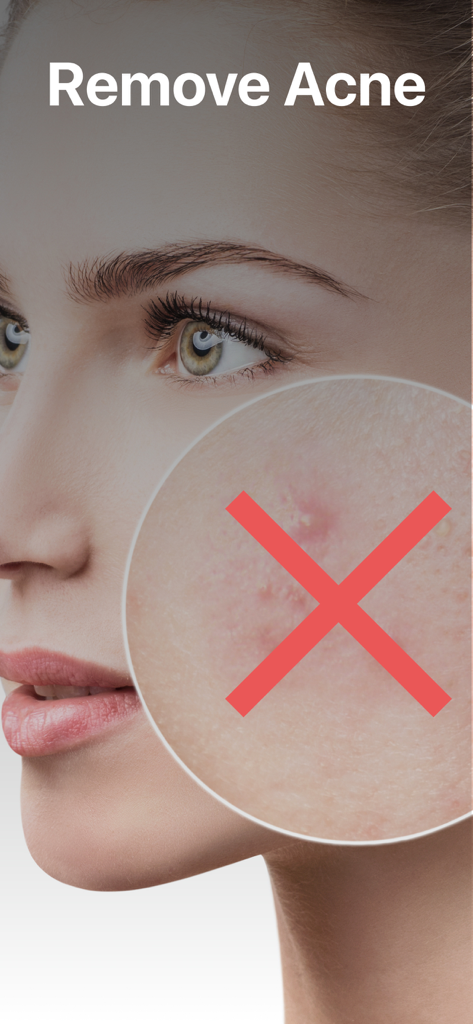 Blemish, Acne, Pimple remover - Magnified view showing acne removal on a woman face