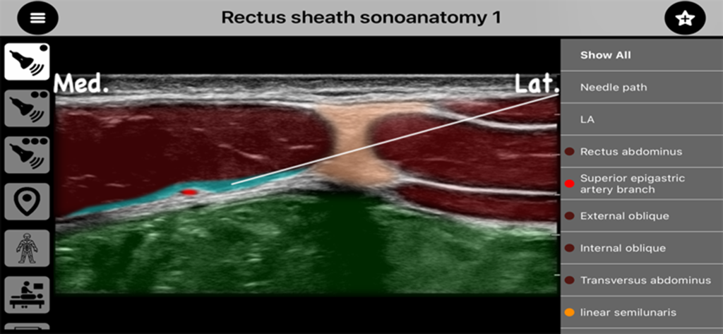 AnSo Pro - Aplicativo AnSo Pro exibindo a sonoanatomia da bainha do reto com sobreposições de cores e orientação do trajeto da agulha