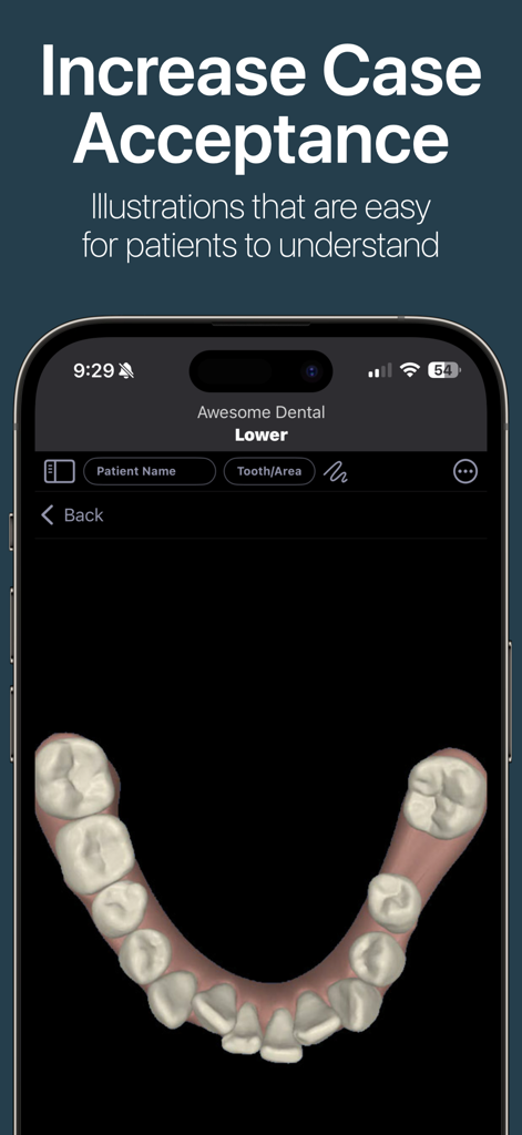 DDS GP - A 3D dental illustration of a lower jaw shown in the DDS GP app for patient consultation.