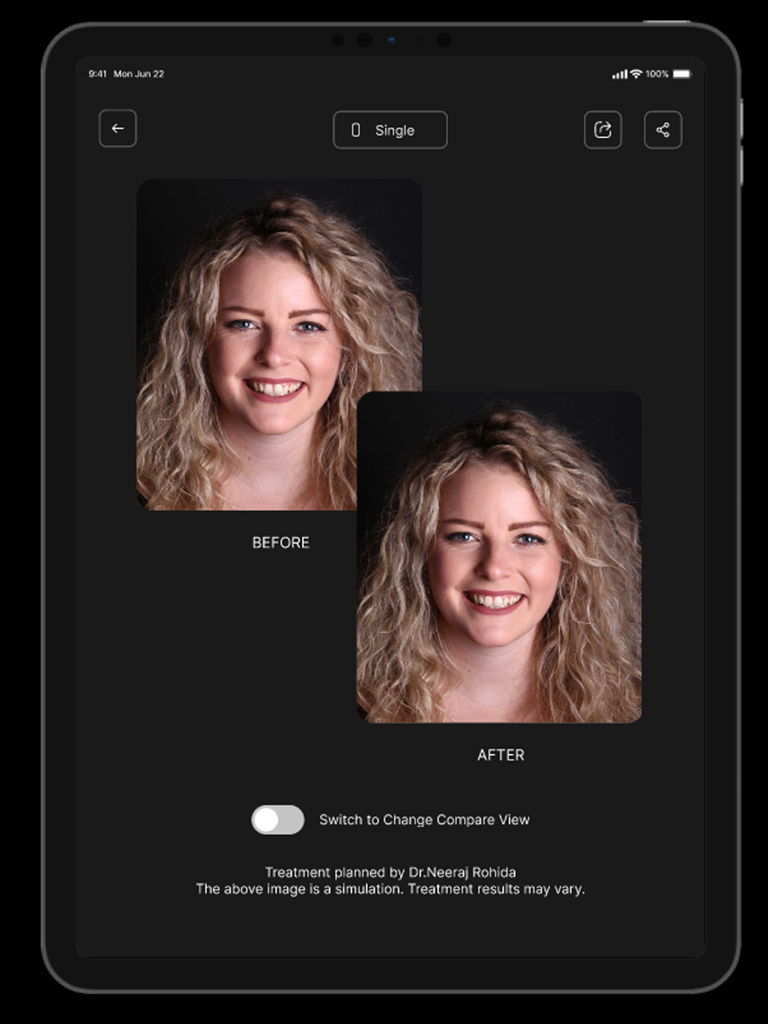 Instant Smiles - Instant Smiles iPad 앱 인터페이스에서 전후 치과 스마일 시뮬레이션