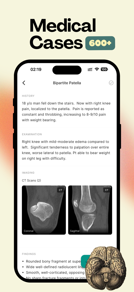 MedDose Pro - MCQs & Diseases - MedDose Pro mobile app interface showing a clinical case study for Bipartite Patella with CT scan images and patient history