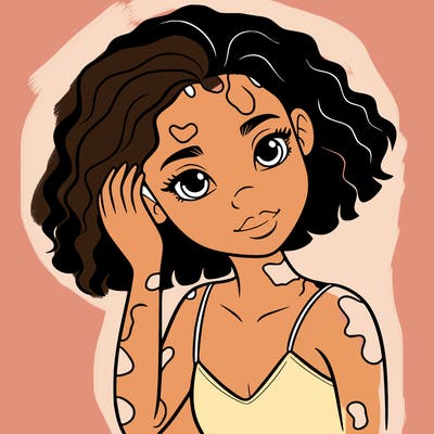 vitiligo black girl
