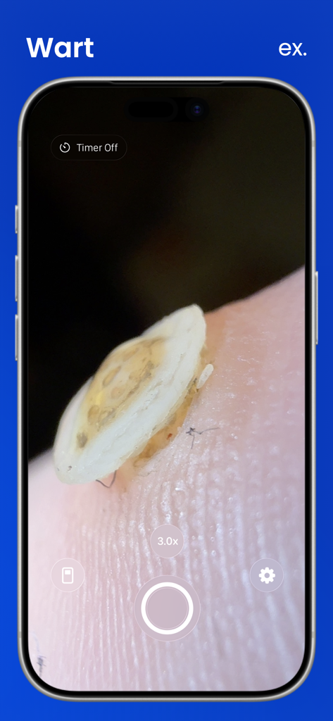Macroscope Cam - Macroscope Cam app on iPhone showing a 3x magnified close up view of a skin wart for inspection